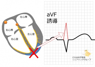 AVF誘導_R波がない.jpg