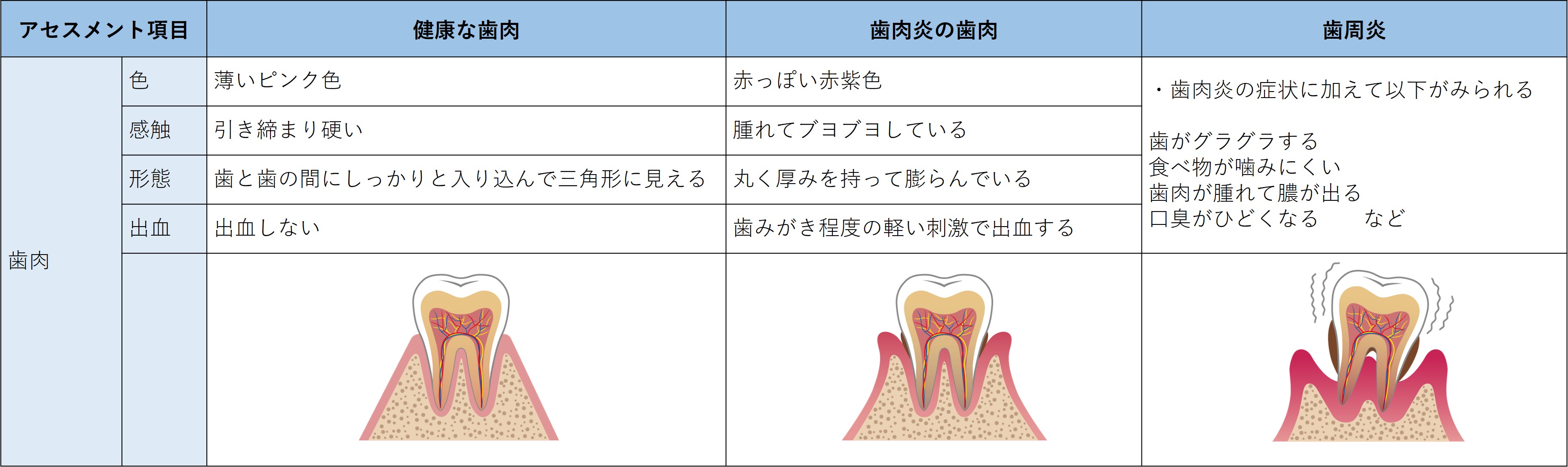 ファイル:表-口-視診4-歯肉の観察.jpg