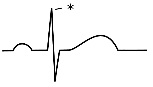 ./images/QRS波の極性_クイズ2.jpg