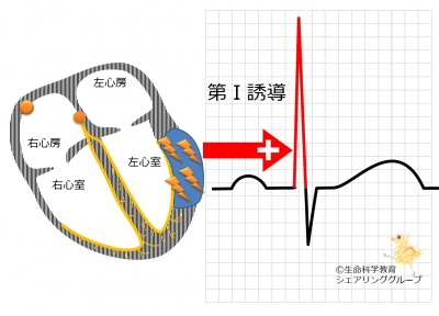 第Ⅰ誘導_R波が高い.jpg