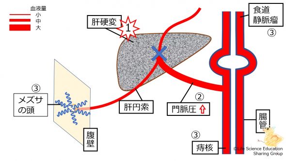 /wiki/images/thumb/b/b1/PortalHypertensionLiverCirrhosis.jpg/590px-PortalHypertensionLiverCirrhosis.jpg