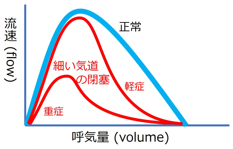 ファイル:FlowVolumeLowerAirwayObstruction.jpg