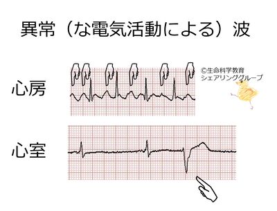 循環器系/心臓/心室の壁、筋/心電図/波形と細胞活動/異常波
