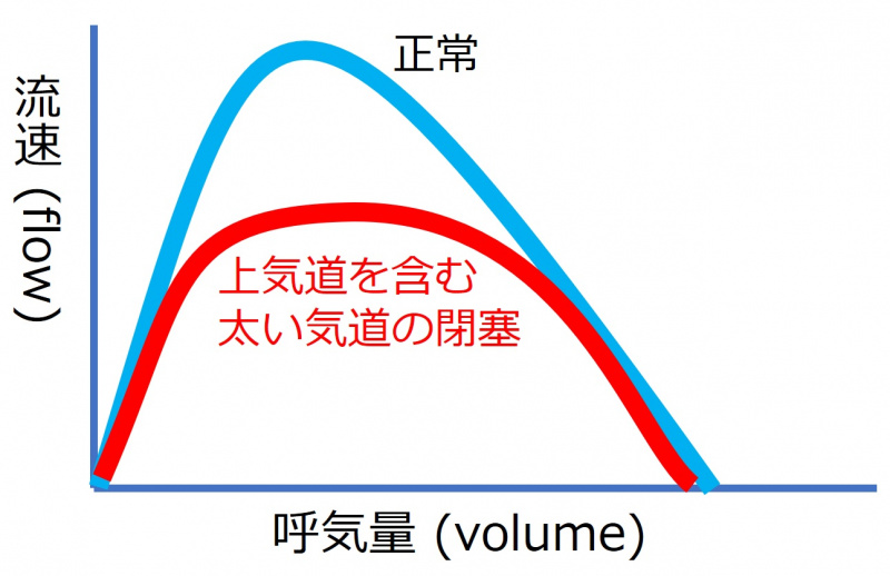 ファイル:FlowVolumeUpperAirwayObstruction.jpg