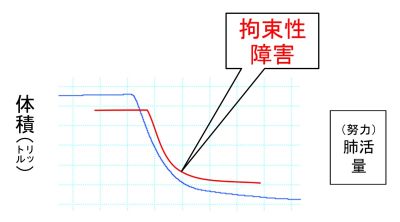 /wiki/images/thumb/f/fe/PulmFuncTestRestrictive-basic.jpg/400px-PulmFuncTestRestrictive-basic.jpg